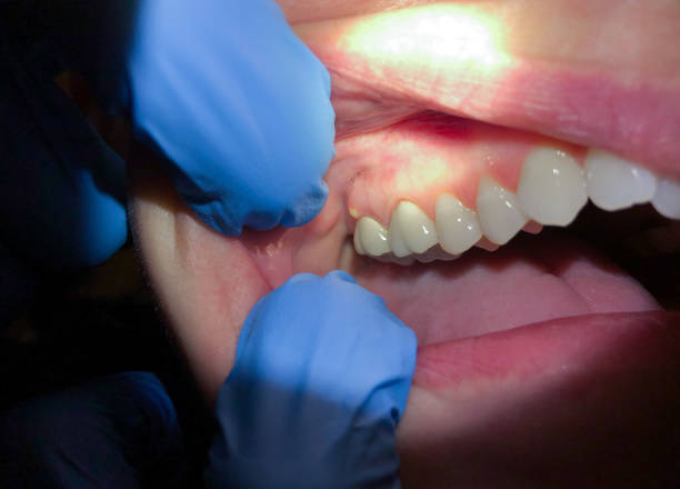 Best Emergency Denture Repair in Aust, IN