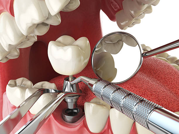 Best Emergency Wisdom Tooth Extraction in Aust, IN